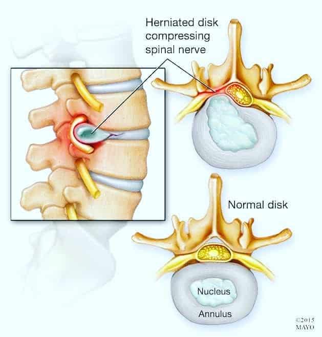 Herniated disc compressing spinal nerve